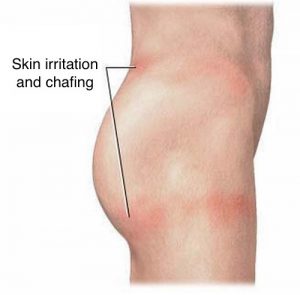 Thigh Sweat Rash - How To Prevent » Chaffree