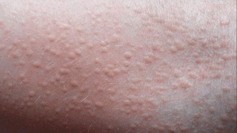 heat sweat rash in groin area » Chaffree